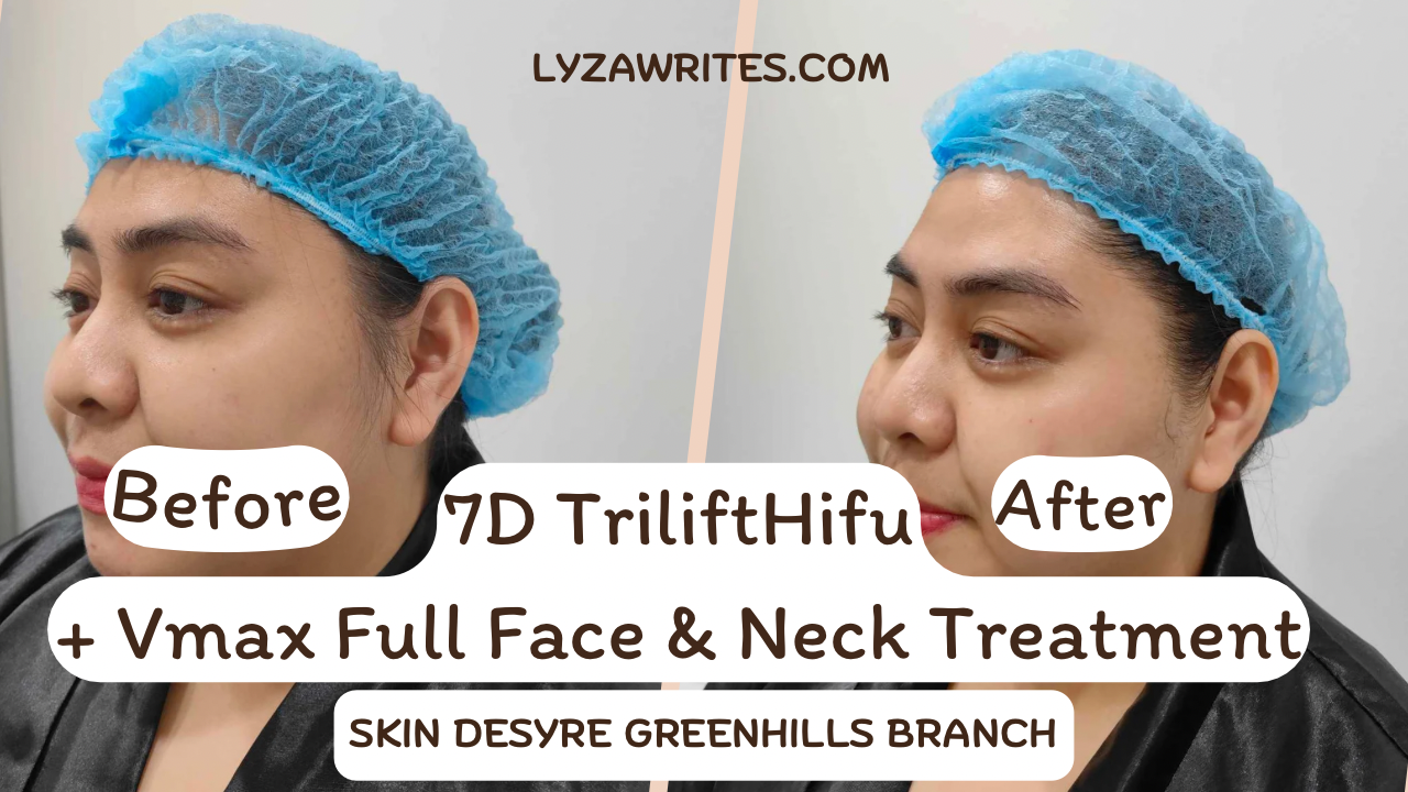 7D TriliftHifu + Vmax Full Face & Neck Treatment with Skin Desyre Greenhills Branch